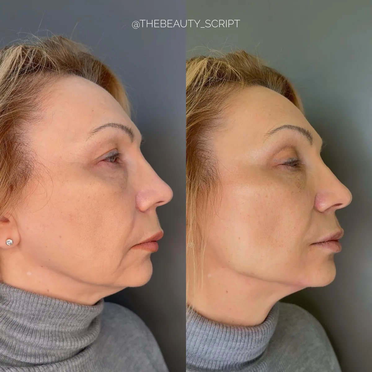 Before and after