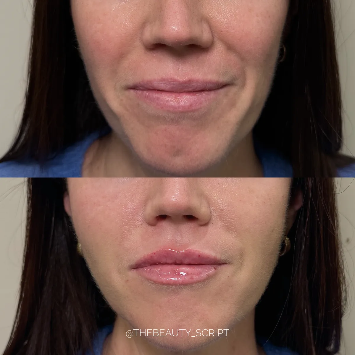 Lower face — before and after