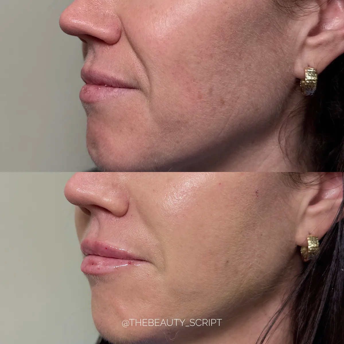 Profile — before and after