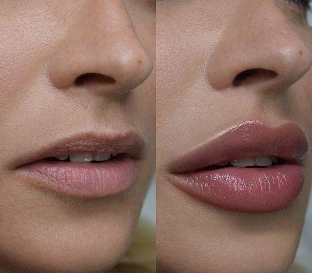 lip filler before and after