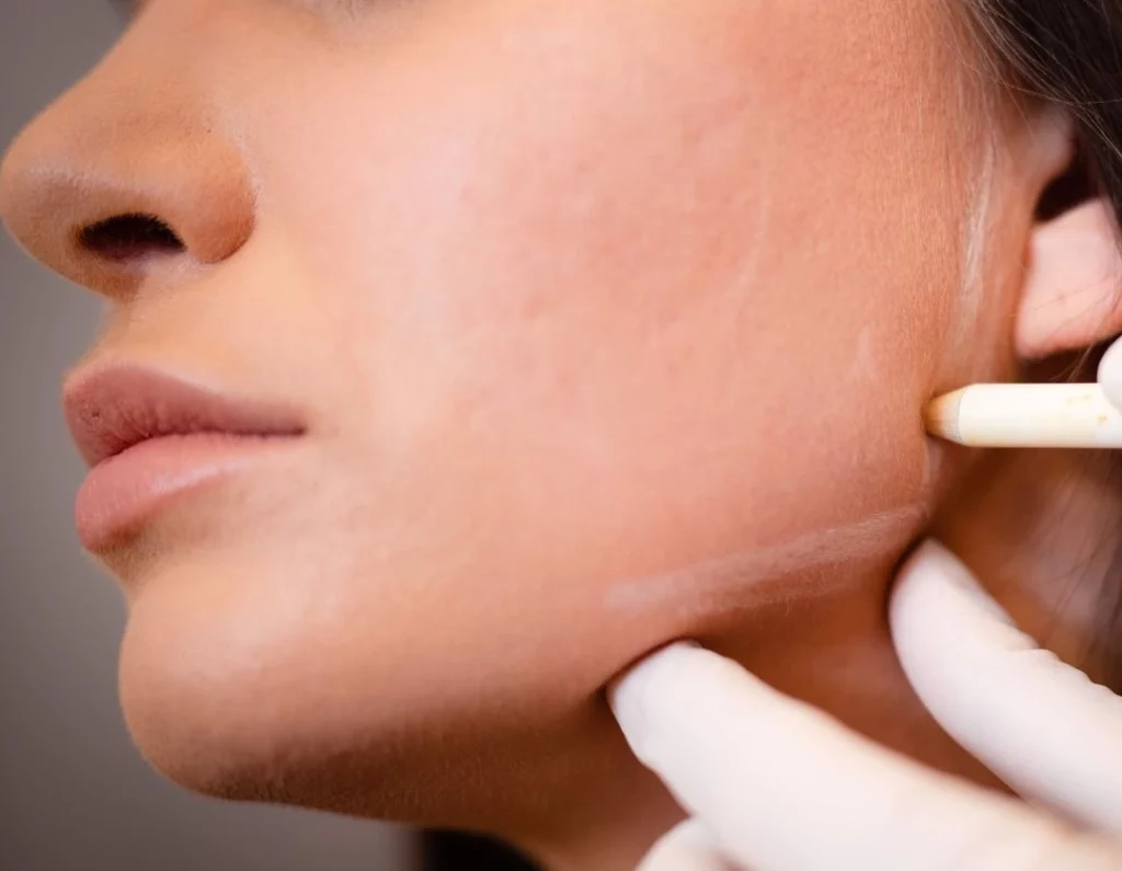 understanding jawline filler in london