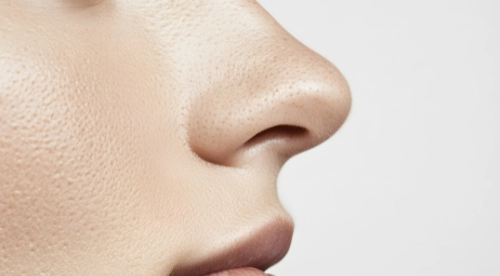 Nonsurgical Rhinoplasty
