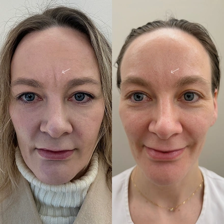 Sunekos Eyes one session before and after