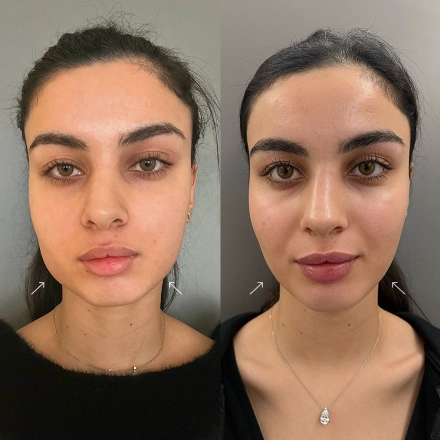 Masseter Botox before and after