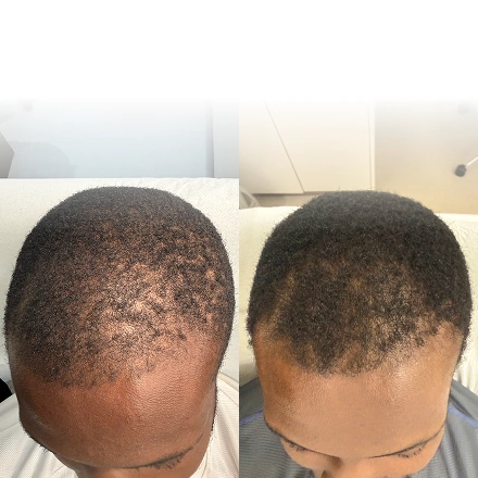 PRP hair restoration before and after